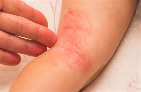 Eczema A Guide To Keeping Your Symptoms At Bay