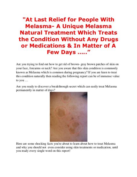 How to cure melasma from the inside home remedies. Melasma natural treatment