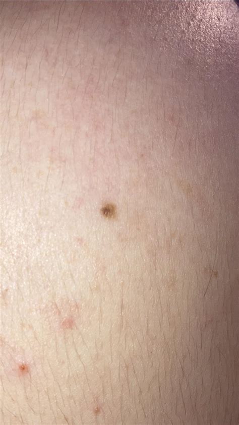 Worried About This Spot On Arm Should I Get It Checked Out Rmelanoma