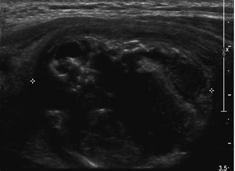 Thyroid Ultrasonography Showing A 31 × 26 × 39 Cm Heterogeneous