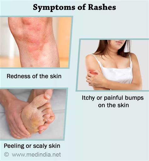 Rashes Types Causes Symptoms Diagnosis Treatment My Xxx Hot Girl