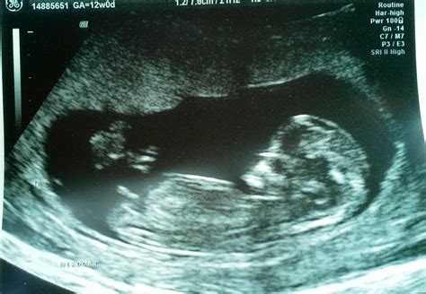 Unexpectedly Expecting Baby Nuchal Scan And 12 Week Ultrasound Pics