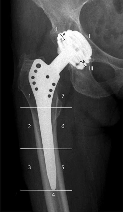 Frontal Radiograph With Gruen Femoral Zones 17 And De Lee Charnley
