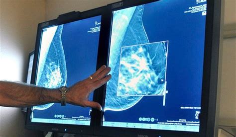 More Women May Need Breast Cancer Gene Test Us Guidelines National Globalnewsca