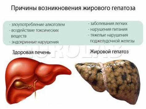 Жировой Гепатоз Печени Симптомы И Лечение Диета — Похудение Диета Картинка - Жировой Гепатоз Печени Симптомы И Лечение Диета — Похудение Диета