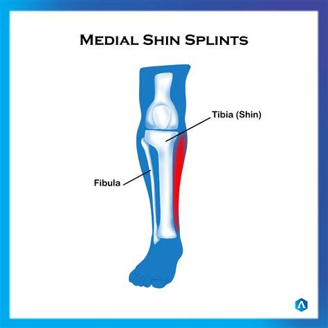 Types Of Shin Splints