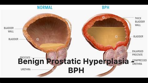 Benign Prostatic Hyperplasia BPH YouTube