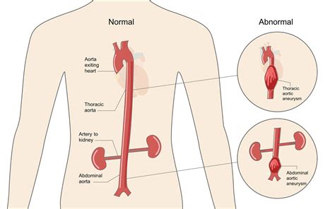 Marfan Syndrome Aortic Aneurysm And Dissection Thoracic Key The Best