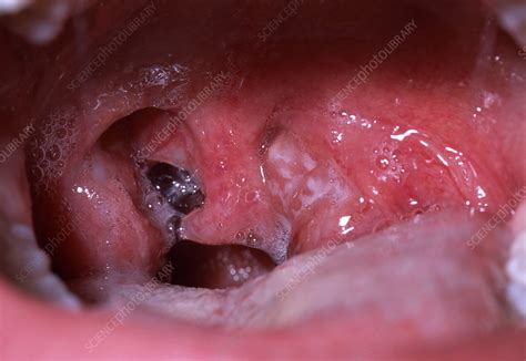 The grim discovery was made by a member of the public as she walked round the back. Mouth abscess - Stock Image - M270/0232 - Science Photo Library
