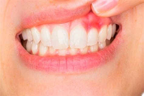 6 Gum Disease Symptoms You Shouldnt Ignore