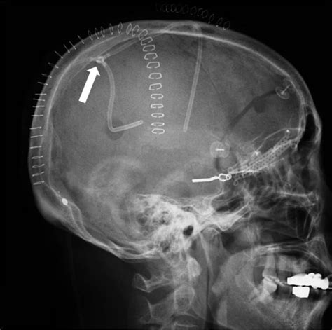 Lateral Skull Radiograph Demonstrating Intracranial Catheters In The