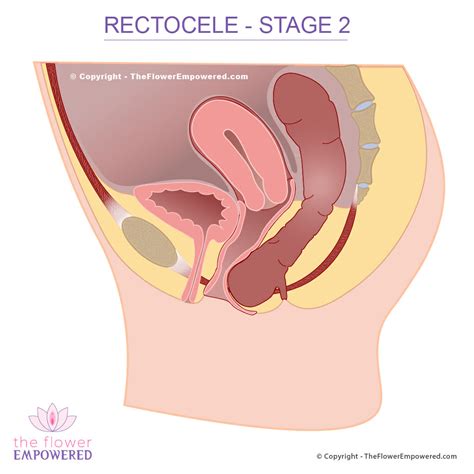 Rectocele Prolapsed Rectum Pelvic Organ Prolapse Stage To