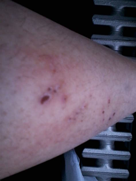 I Have Some Scabs A Scratch On My Shinbone My Leg I Had Them