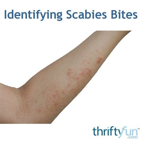 A Scabies Rash Is Caused By A Microscopic Mite And They Often Start To
