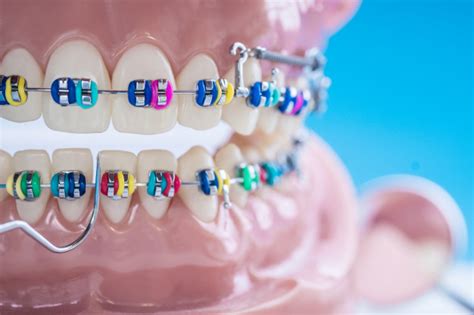 Ortodoncia De Colores ¿cómo Elegir El Mejor Color Dentalcare Clinicas