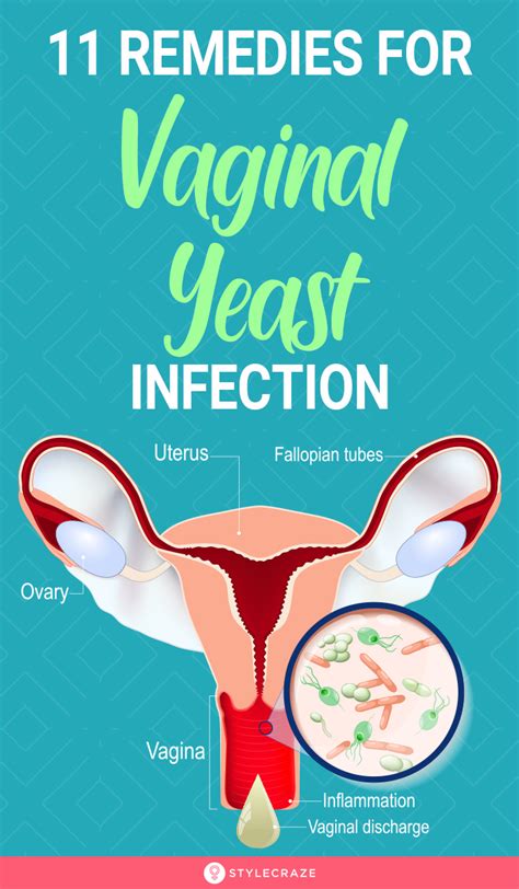 11 Best Home Remedies For Yeast Infection That Actually Work Artofit