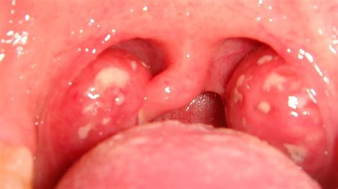 Allergy And Swollen Tonsils Free Nude Porn Photos