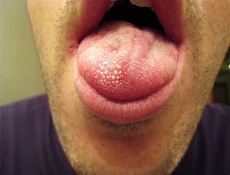 Inflamed Taste Bud Pictures Meandastranger