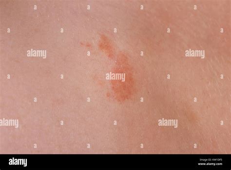The Great Red Spot On The Skin Closeup Stock Photo Alamy