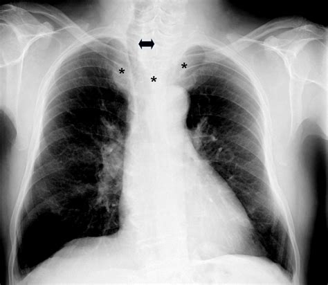 Mediastinal Goiter And Tracheal Deviation At CXR Asterisks