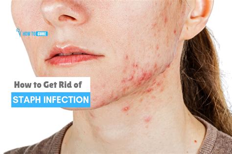 How To Get Rid Of Staph Infection In 5 Miraculous Ways How To Cure