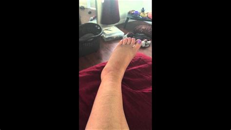 Day 2 Avulsion Fracture Ankle Sprain And Self Care Youtube