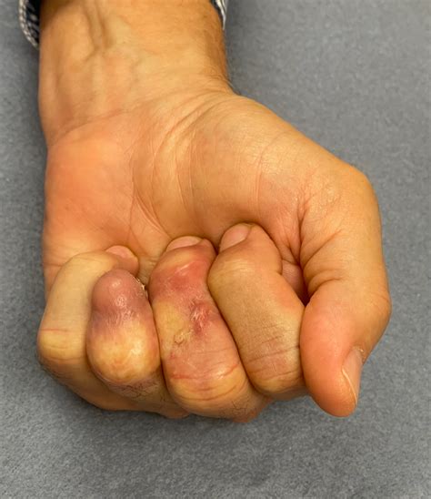 A Novel Approach In Management Of Ring Avulsion Injuries Not Amenable