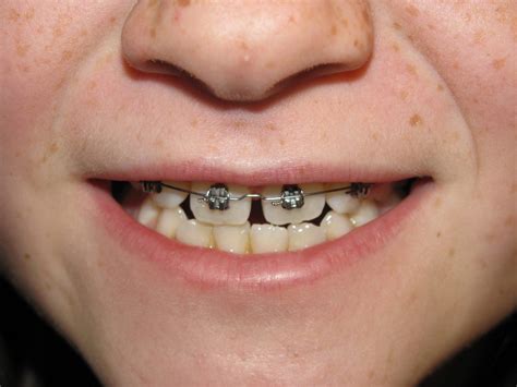 Does Your Child Need Braces? - Kidds Place