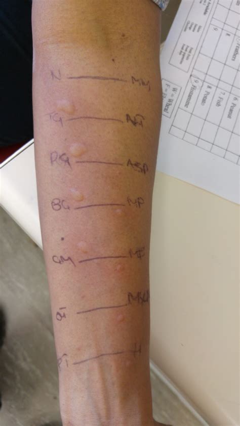 Allergy Skin Prick Test Afsa