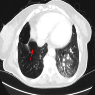 Chest High Resolution Computed Tomography Scan Demonstrating