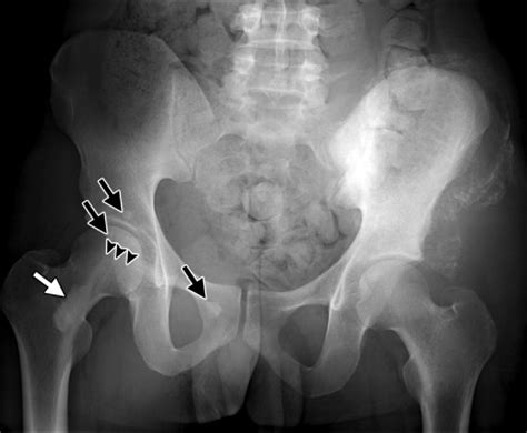 Overlap Syndrome In A 25 Year Old Man Pelvic Radiograph Obtained For