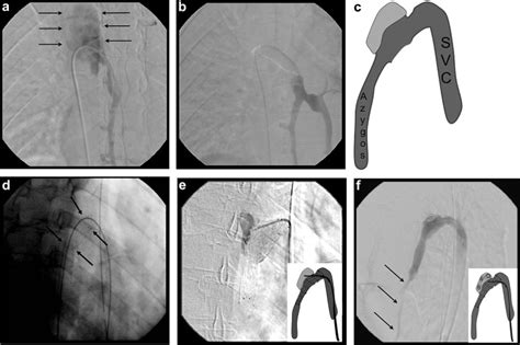 Feasibility And Safety Of Endovascular Treatment For Chronic