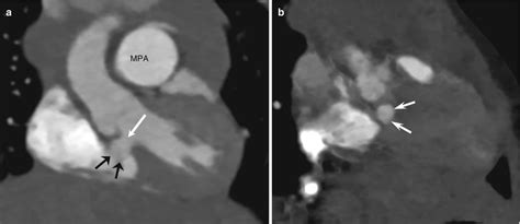 Ct And Mri Findings Of Cardiac Defects In Congenital Heart Disease