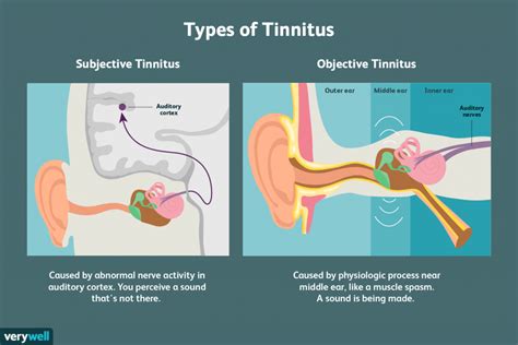 What Causes Ringing In The Ears What Causes Ringing In The Ears