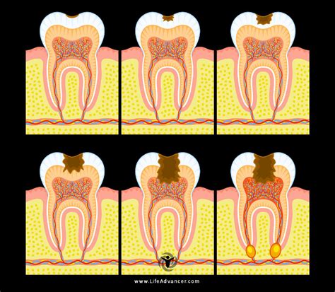 Tooth Infection Symptoms Causes And Natural Relief Remedies