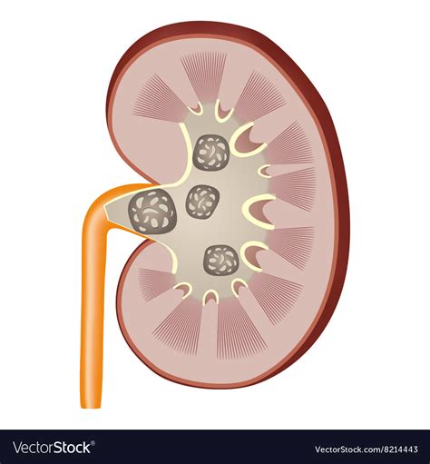 Kidney Stones Royalty Free Vector Image Vectorstock
