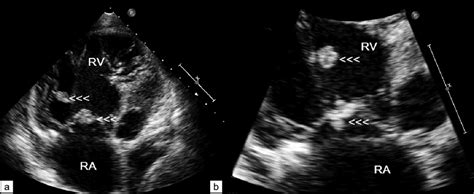 Transthoracic Echocardiography A And B Showing Multiple Vegetations