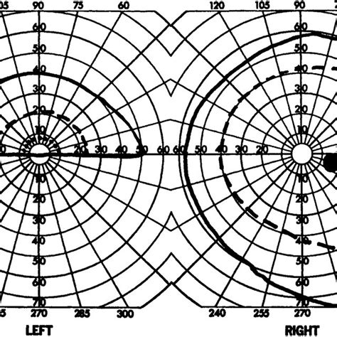 Goldmanns Visual Field Chart Note The Inferior Altitudinal Defect In