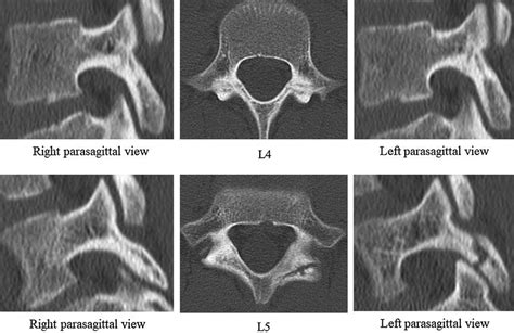 Ct Scans Obtained 15 Weeks Later Showing Bone Union At L4 And Complete