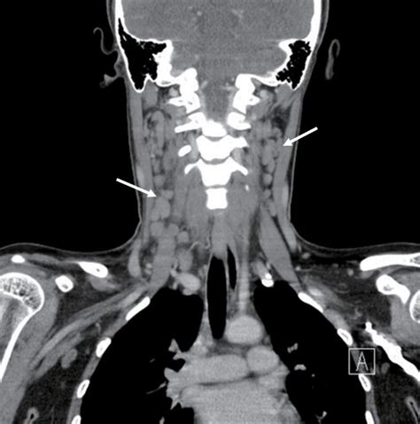 Computed Tomography Of The Neck Shows Multiple Enlarged Lymph Nodes On