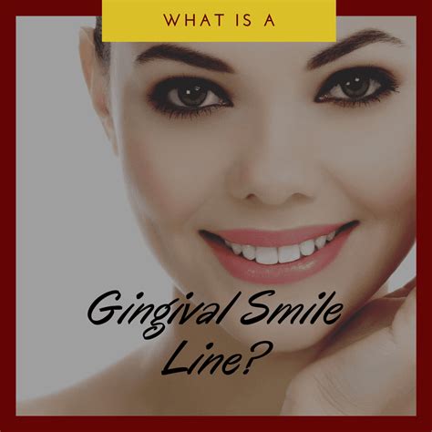 What Is The Gingival Smile Line West Palm Beach Dentist
