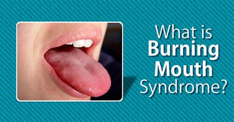 The Burning Mouth Syndrome Is A Painful Complex Condition And Often