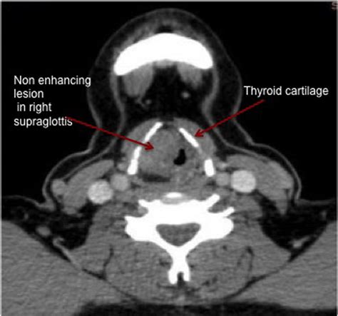 Axial Contrast Enhanced Ct Scan Of Larynx Download Scientific Diagram