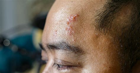 Shingles In Young Adults Why It‘s Possible Symptoms And More
