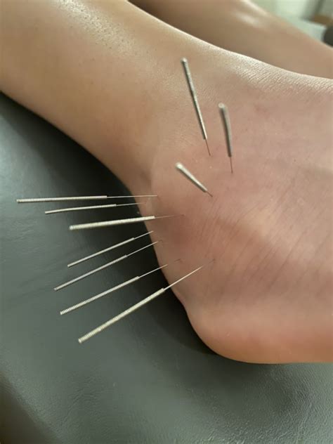 functional dry needling and ims