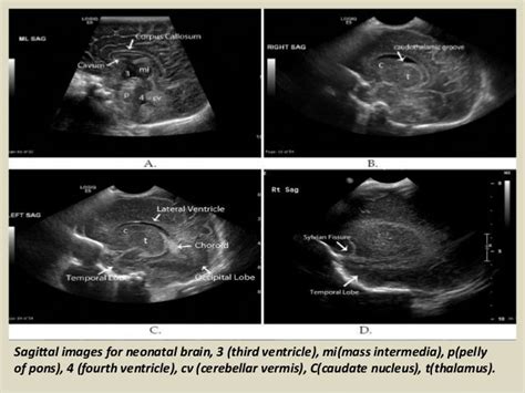 Ultrasound Neonatal Head Ventricles