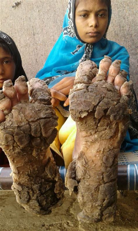 Rare Skin Disease Is Turning Feet And Hands Of These