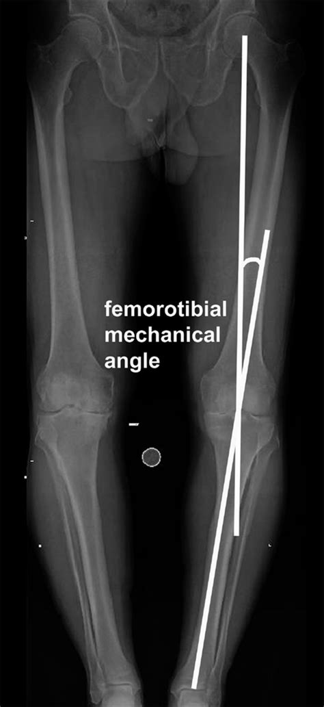 Frontiers Dynamic Knee Alignment And Collateral Knee Laxity And Its