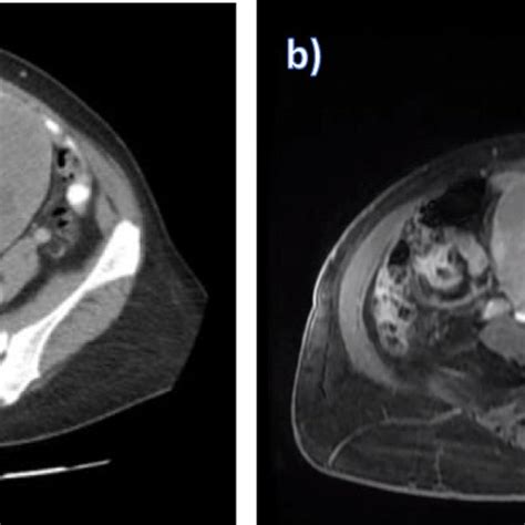 Ct Scan A Showed Large Heterogeneous Uterine Mass Measuring 145 ×