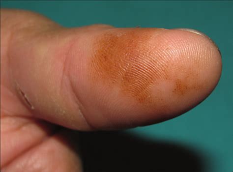 Hyperpigmented Asymptomatic Macule In A Fingertip With Suspicious